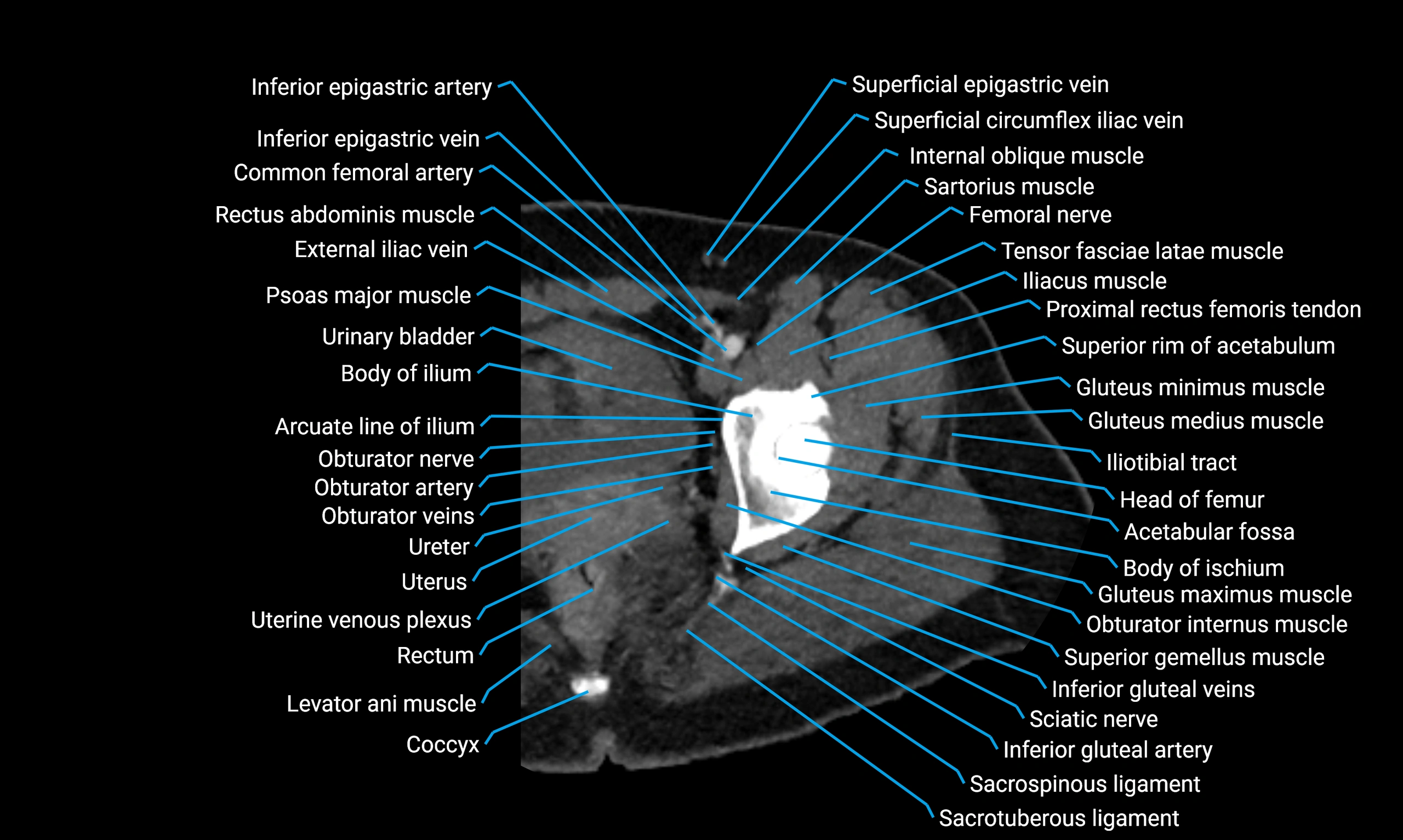 CT lower limb axial cross sectional anatomy labelled image 4 (2).webp